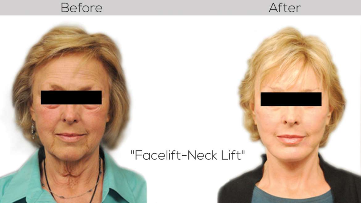 Look Twenty Years Younger with Facelifts and Neck lifts