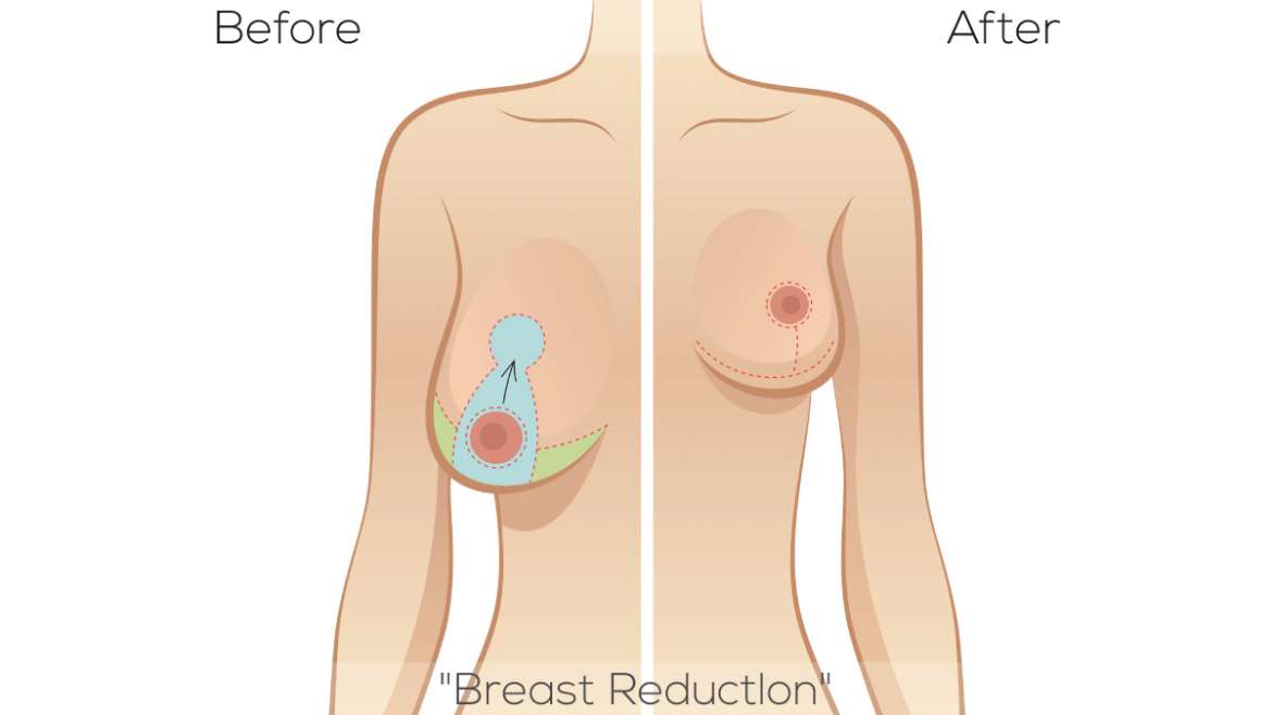 Is Breast Reduction and Breast Lift Surgery – A Smart Choice?