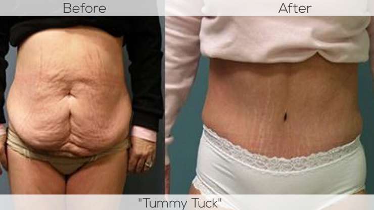 MUMMY MAKE OVER –  Want To Get Back to Your Pre-Pregnancy Shape? Just ‘Tuck Up’ with A Tummy Tuck!