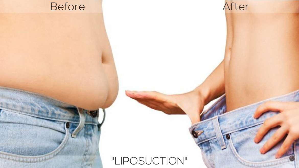 Let’s peep into the Key Advantages of Liposuction Surgery