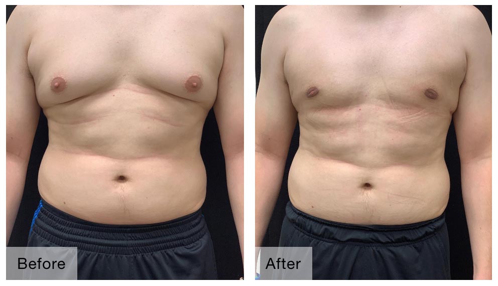 Male Breast Reduction - Synergy Male Breast Reduction Surgery Surat
